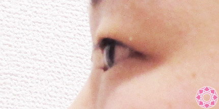 年代：10代 施術名：二重埋没法 施術前｜【公式】東京形成美容外科