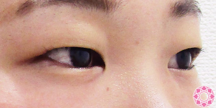 年代：10代 施術名：二重埋没法 施術前｜【公式】東京形成美容外科