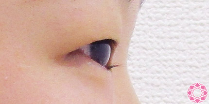 年代：10代 施術名：二重埋没法 施術前｜【公式】東京形成美容外科