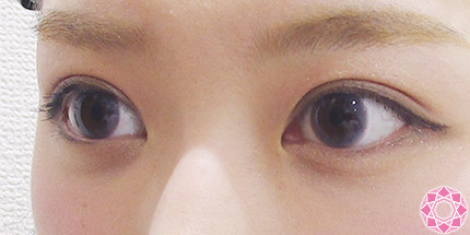 年代：20代 施術名：二重埋没法 施術後｜【公式】東京形成美容外科