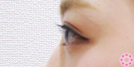 年代：20代 施術名：二重埋没法 施術後｜【公式】東京形成美容外科