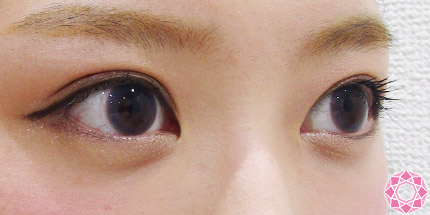 年代：20代 施術名：二重埋没法 施術後｜【公式】東京形成美容外科