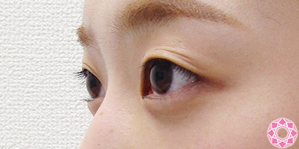 年代：20代 施術名：二重埋没法 施術前｜【公式】東京形成美容外科