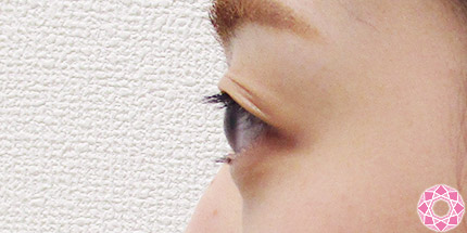 年代：20代 施術名：二重埋没法 施術前｜【公式】東京形成美容外科