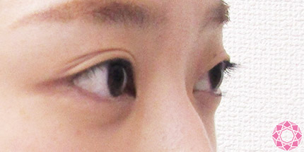 年代：20代 施術名：二重埋没法 施術前｜【公式】東京形成美容外科