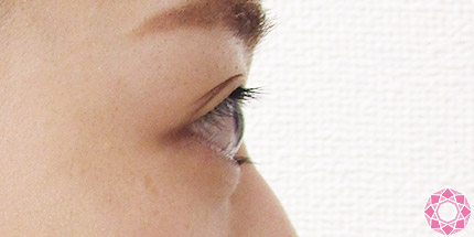 年代：20代 施術名：二重埋没法 施術前｜【公式】東京形成美容外科