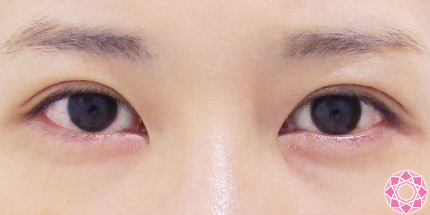 年代：20代 施術名：二重埋没法 施術後｜【公式】東京形成美容外科