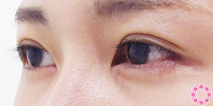 年代：20代 施術名：二重埋没法 施術後｜【公式】東京形成美容外科