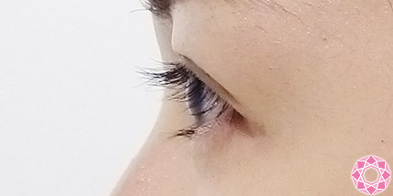 年代：20代 施術名：二重埋没法 施術後｜【公式】東京形成美容外科