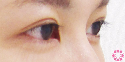 年代：20代 施術名：二重埋没法 施術後｜【公式】東京形成美容外科