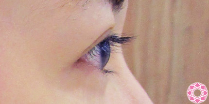 年代：20代 施術名：二重埋没法 施術後｜【公式】東京形成美容外科