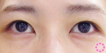 年代：20代 施術名：二重埋没法 施術前｜【公式】東京形成美容外科