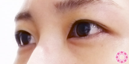 年代：20代 施術名：二重埋没法 施術前｜【公式】東京形成美容外科