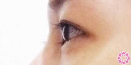 年代：20代 施術名：二重埋没法 施術前｜【公式】東京形成美容外科