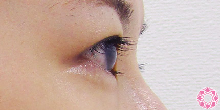 年代：20代 施術名：二重埋没法 施術前｜【公式】東京形成美容外科