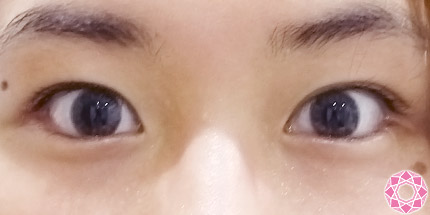 年代：20代 施術名：二重埋没法 施術後｜【公式】東京形成美容外科