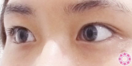 年代：20代 施術名：二重埋没法 施術後｜【公式】東京形成美容外科