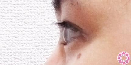 年代：20代 施術名：二重埋没法 施術後｜【公式】東京形成美容外科