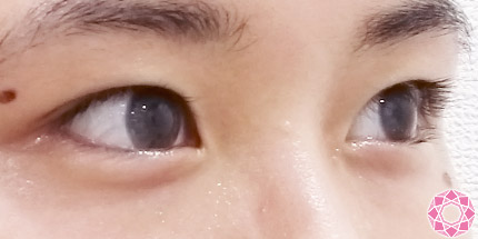 年代：20代 施術名：二重埋没法 施術後｜【公式】東京形成美容外科