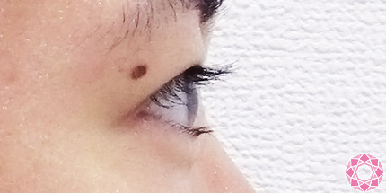 年代：20代 施術名：二重埋没法 施術後｜【公式】東京形成美容外科