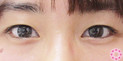 年代：20代 施術名：二重埋没法 施術前｜【公式】東京形成美容外科