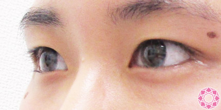 年代：20代 施術名：二重埋没法 施術前｜【公式】東京形成美容外科