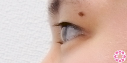 年代：20代 施術名：二重埋没法 施術前｜【公式】東京形成美容外科