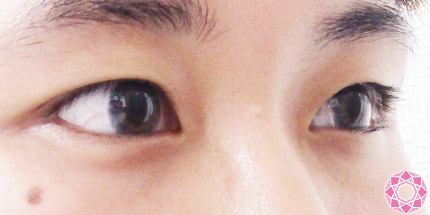 年代：20代 施術名：二重埋没法 施術前｜【公式】東京形成美容外科