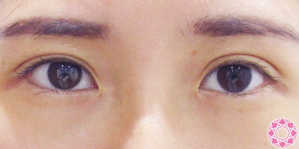 年代：20代 施術名：二重埋没法 施術後｜【公式】東京形成美容外科