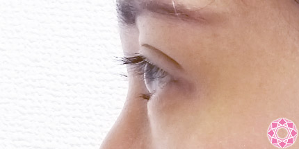 年代：20代 施術名：二重埋没法 施術後｜【公式】東京形成美容外科