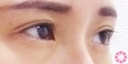 年代：20代 施術名：二重埋没法 施術後｜【公式】東京形成美容外科