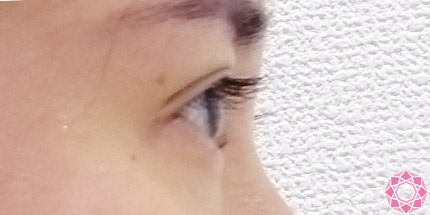 年代：20代 施術名：二重埋没法 施術後｜【公式】東京形成美容外科