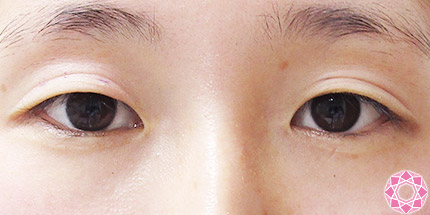 年代：20代 施術名：二重埋没法 施術前｜【公式】東京形成美容外科