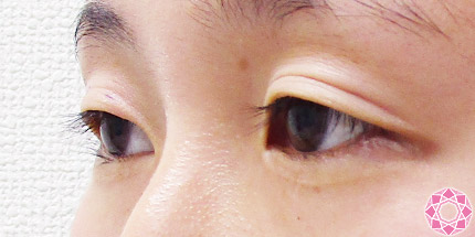 年代：20代 施術名：二重埋没法 施術前｜【公式】東京形成美容外科