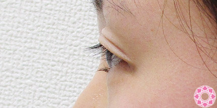 年代：20代 施術名：二重埋没法 施術前｜【公式】東京形成美容外科