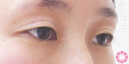 年代：20代 施術名：二重埋没法 施術前｜【公式】東京形成美容外科