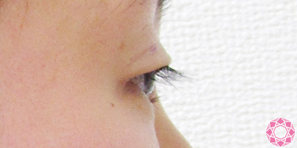 年代：20代 施術名：二重埋没法 施術前｜【公式】東京形成美容外科