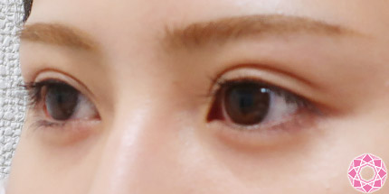 年代：20代 施術名：二重埋没法 施術後｜【公式】東京形成美容外科