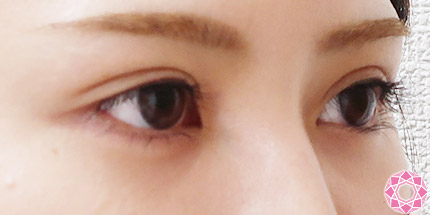 年代：20代 施術名：二重埋没法 施術後｜【公式】東京形成美容外科