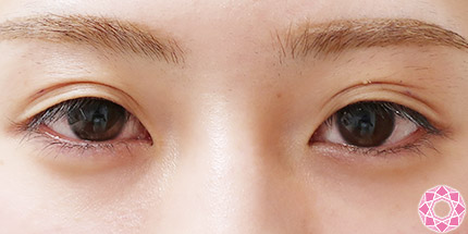 年代：20代 施術名：二重埋没法 施術前｜【公式】東京形成美容外科