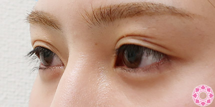 年代：20代 施術名：二重埋没法 施術前｜【公式】東京形成美容外科