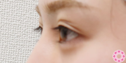 年代：20代 施術名：二重埋没法 施術前｜【公式】東京形成美容外科