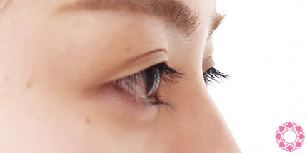 年代：20代 施術名：二重埋没法 施術前｜【公式】東京形成美容外科