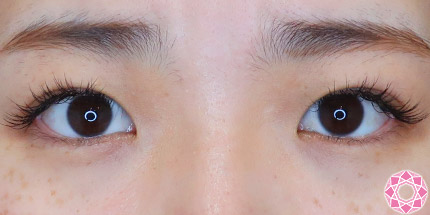 年代：20代 施術名：二重埋没法 施術後｜【公式】東京形成美容外科