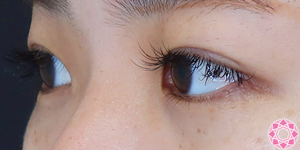 年代：20代 施術名：二重埋没法 施術後｜【公式】東京形成美容外科