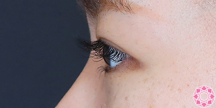 年代：20代 施術名：二重埋没法 施術後｜【公式】東京形成美容外科