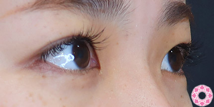 年代：20代 施術名：二重埋没法 施術後｜【公式】東京形成美容外科