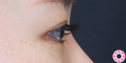 年代：20代 施術名：二重埋没法 施術後｜【公式】東京形成美容外科