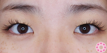 年代：20代 施術名：二重埋没法 施術前｜【公式】東京形成美容外科