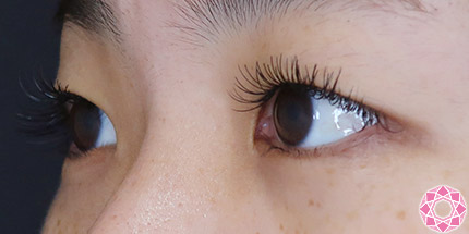 年代：20代 施術名：二重埋没法 施術前｜【公式】東京形成美容外科